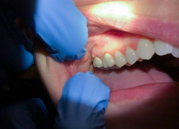 Best Emergency Treatment for Dental Infections or Abscesses in Palisade, CO